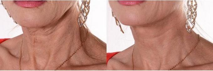 Beauty-strange: why women glue tape on the neck